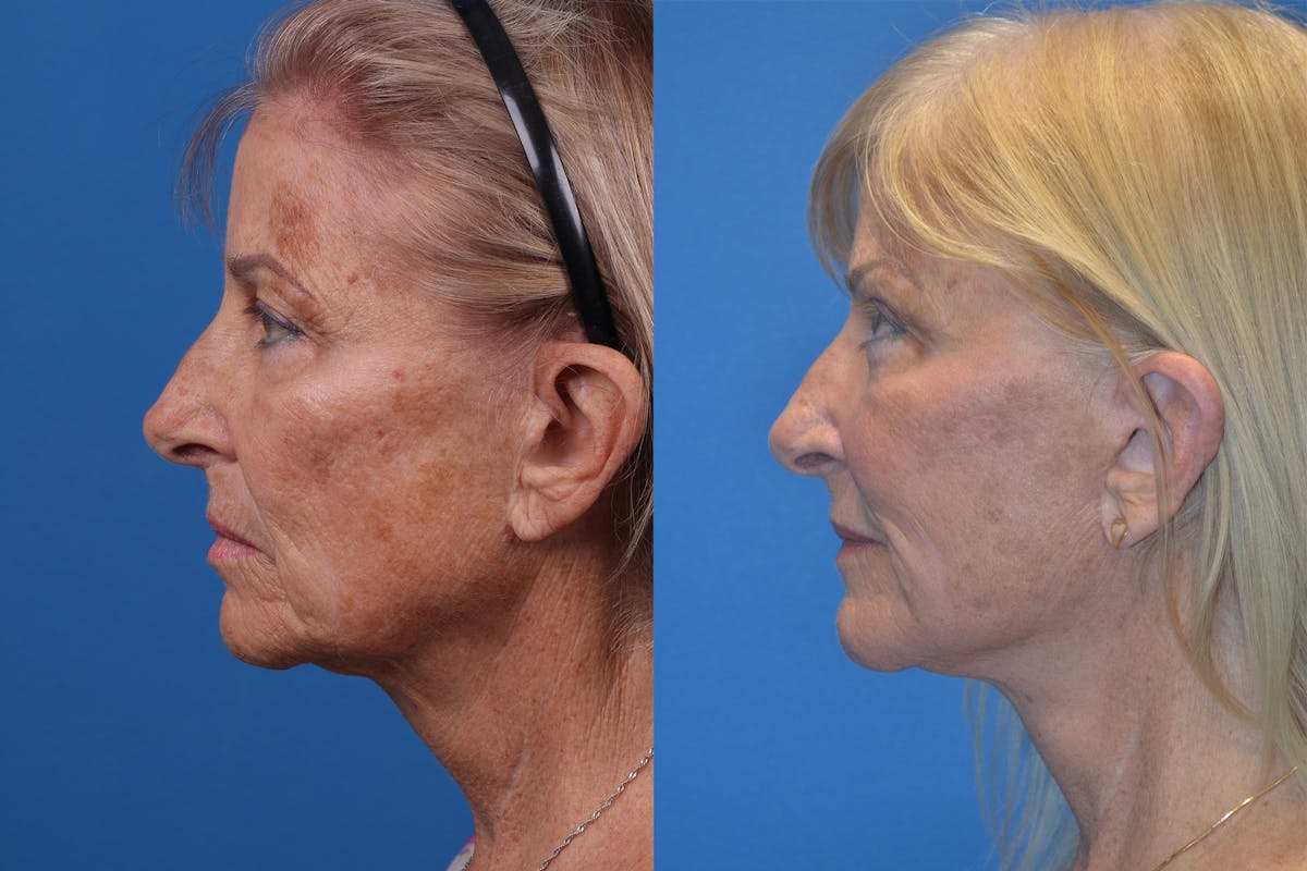 Skin Resurfacing Before & After Gallery - Patient 148466794 - Image 5