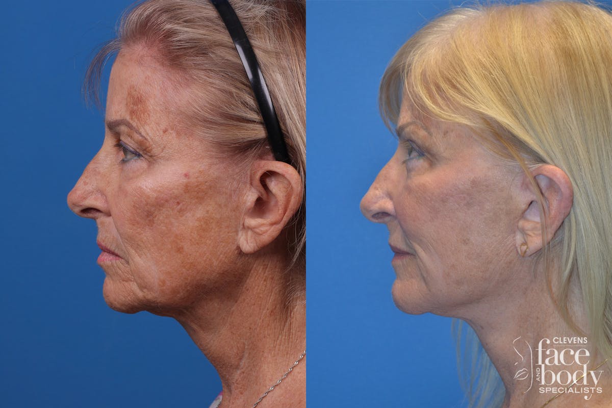 Skin Resurfacing Before & After Gallery - Patient 148466794 - Image 5