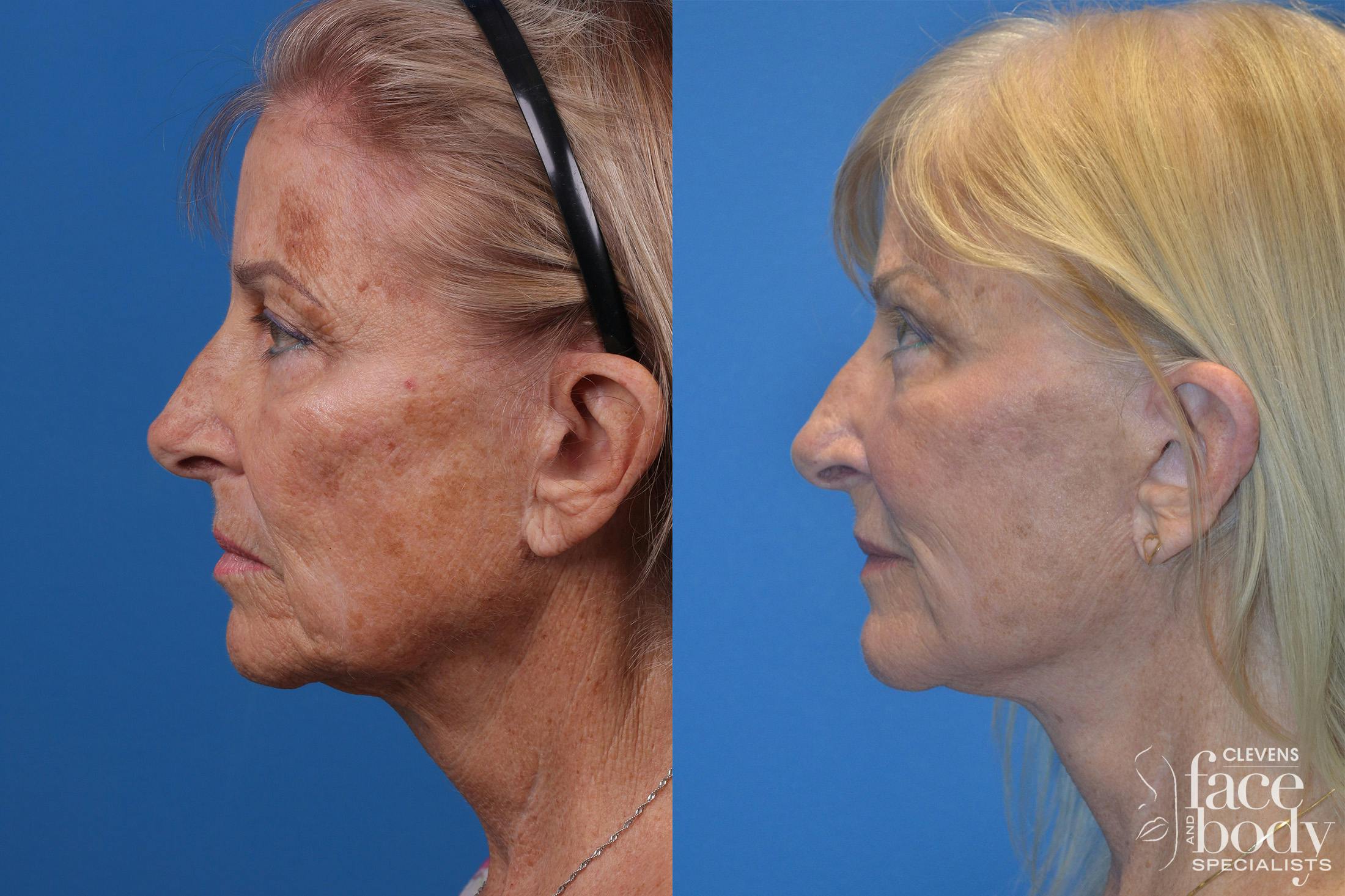 Skin Resurfacing Before & After Gallery - Patient 148466794 - Image 5