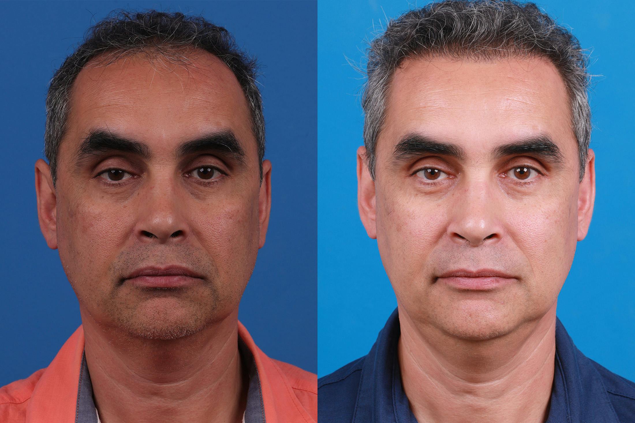 Hair Restoration Before & After Gallery - Patient 148467004 - Image 1
