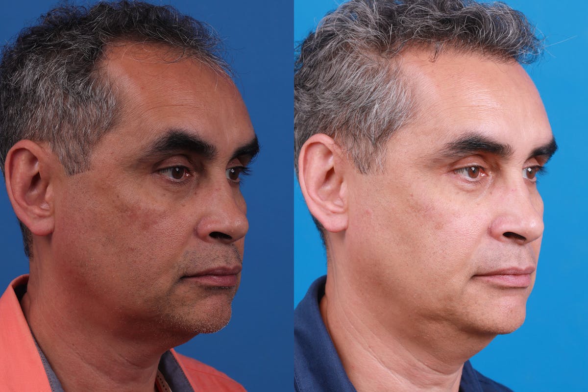 Hair Restoration Before & After Gallery - Patient 148467004 - Image 2