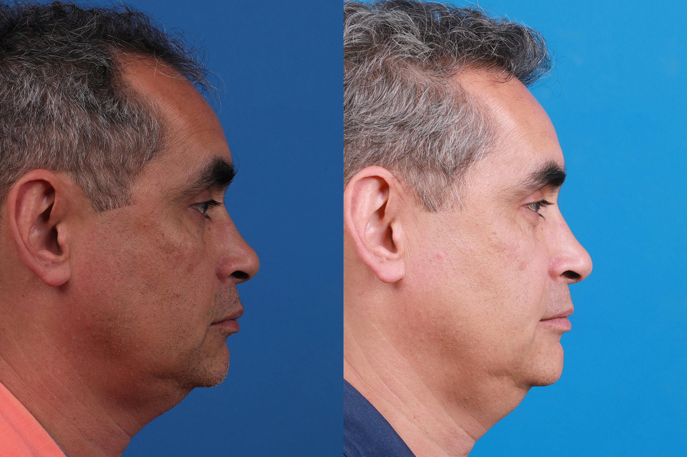 Hair Restoration Before & After Gallery - Patient 148467004 - Image 3