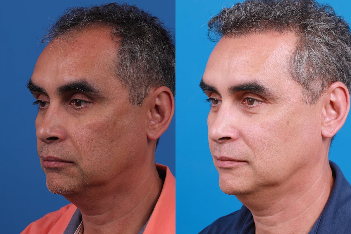 Hair Restoration Before & After Gallery - Patient 148467004 - Image 4