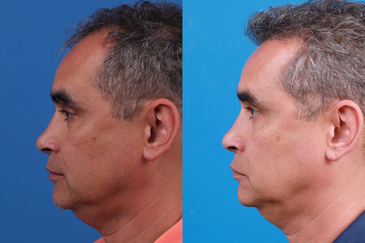 Hair Restoration Before & After Gallery - Patient 148467004 - Image 5