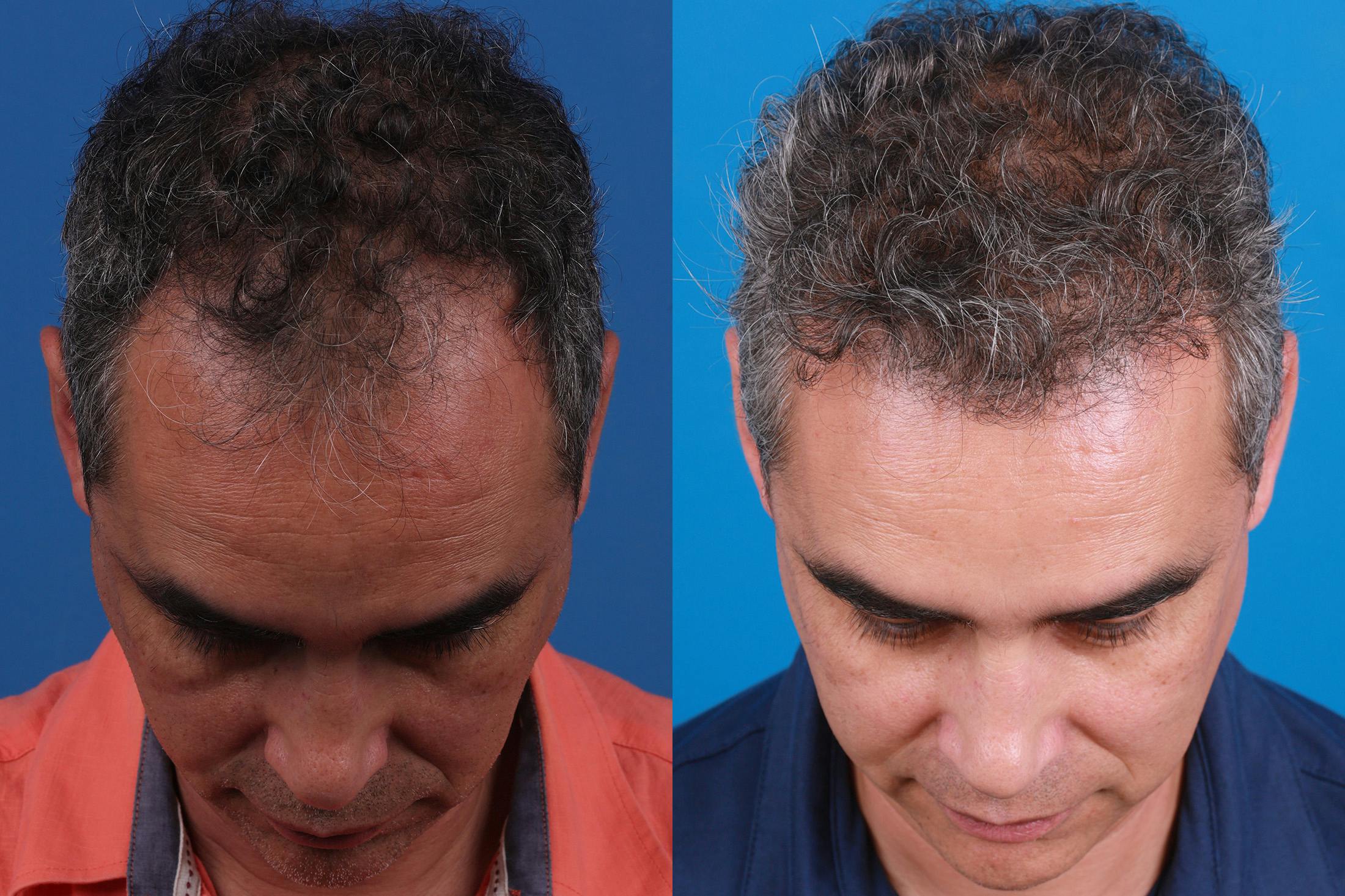 Hair Restoration Before & After Gallery - Patient 148467004 - Image 6