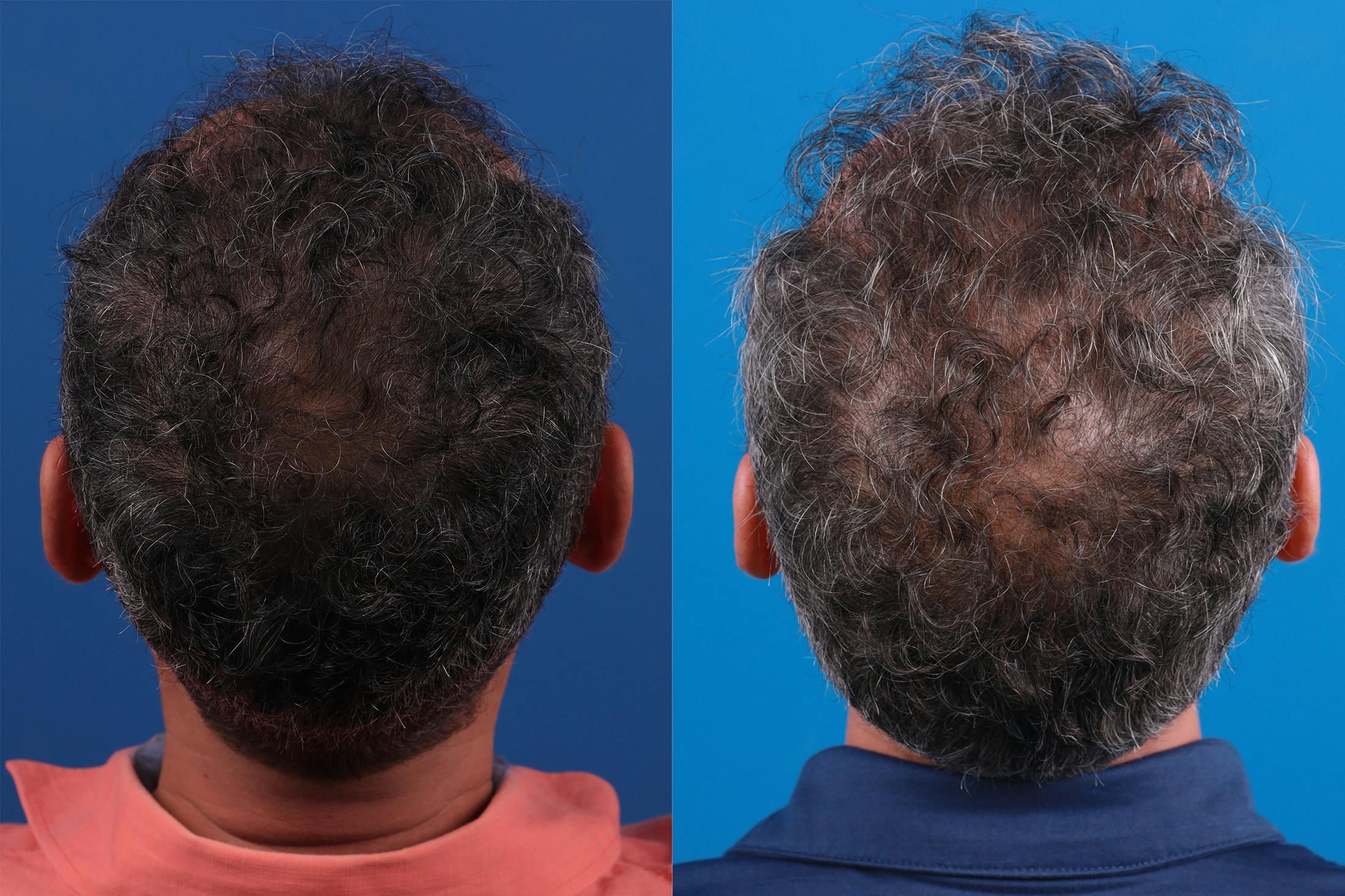 Hair Restoration Before & After Gallery - Patient 148467004 - Image 7