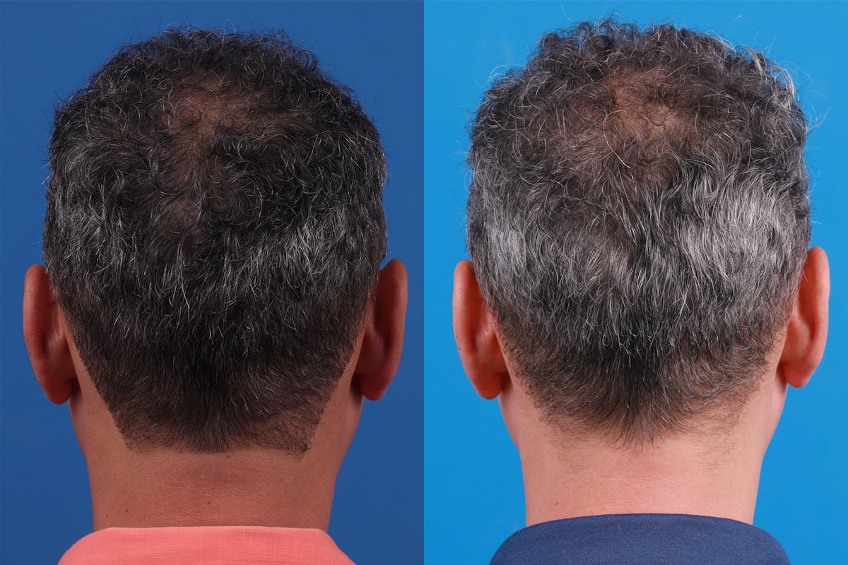 Hair Restoration Before & After Gallery - Patient 148467004 - Image 8
