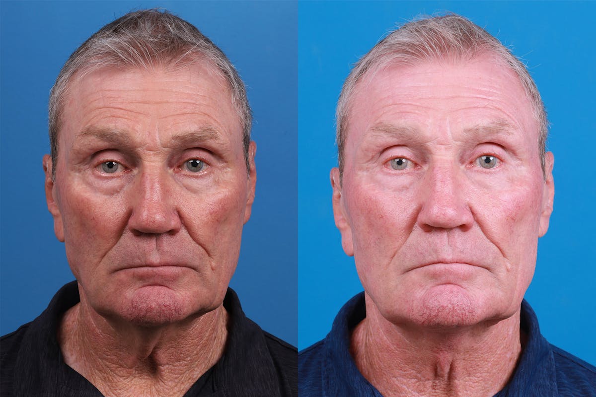 Profile Neck Lift Before & After Gallery - Patient 148467033 - Image 1