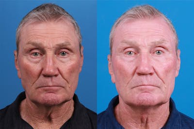 Profile Neck Lift Before & After Gallery - Patient 148467033 - Image 1