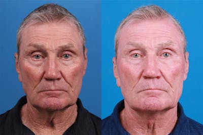 Male Neck Lift Before & After Gallery - Patient 148538117 - Image 1