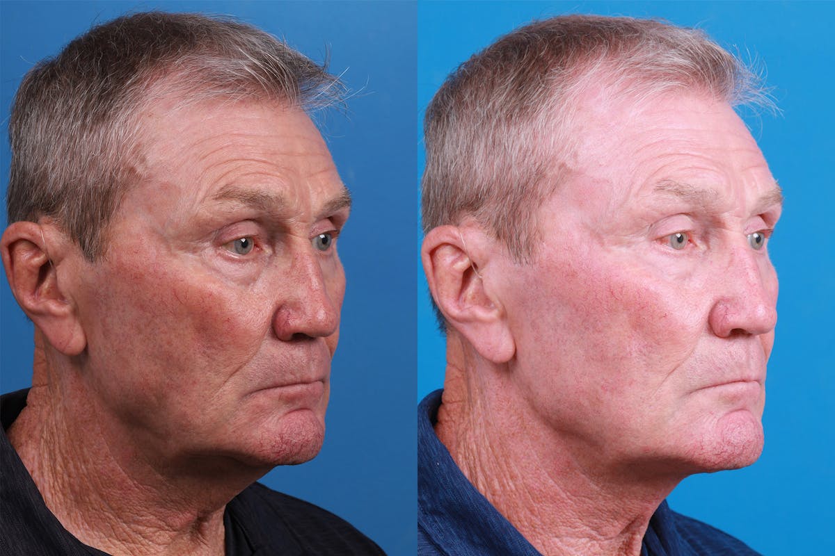 Male Neck Lift Before & After Gallery - Patient 148538117 - Image 2