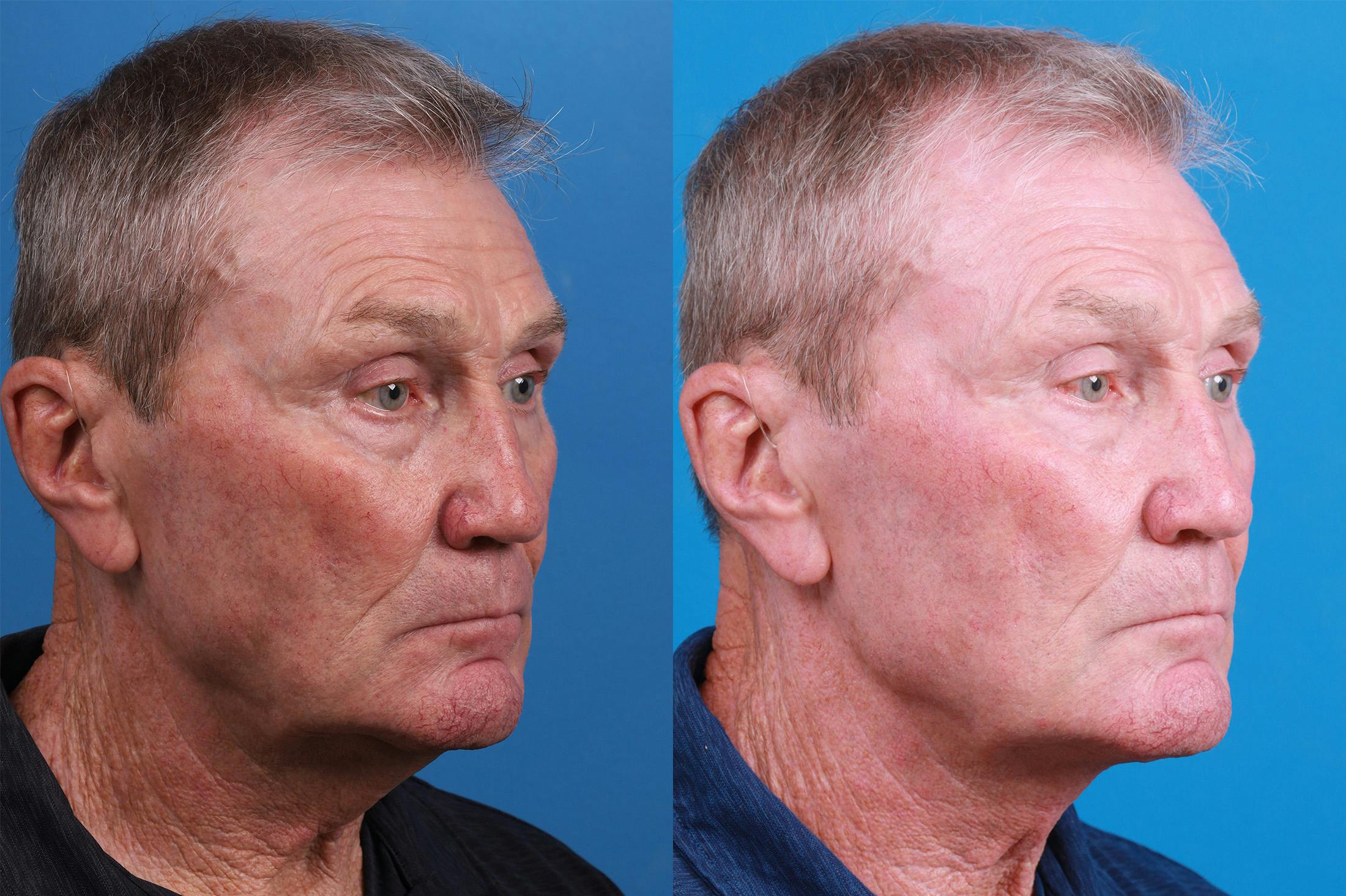 Profile Neck Lift Before & After Gallery - Patient 148467033 - Image 2