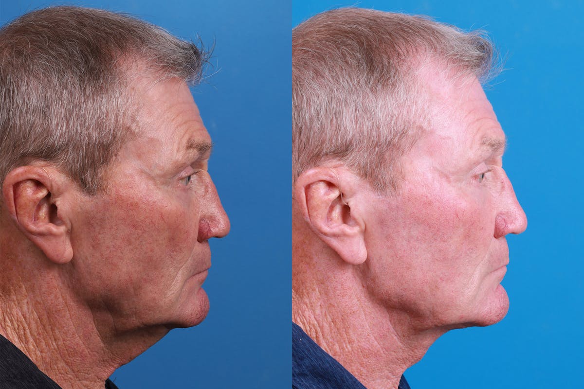 Profile Neck Lift Before & After Gallery - Patient 148467033 - Image 3