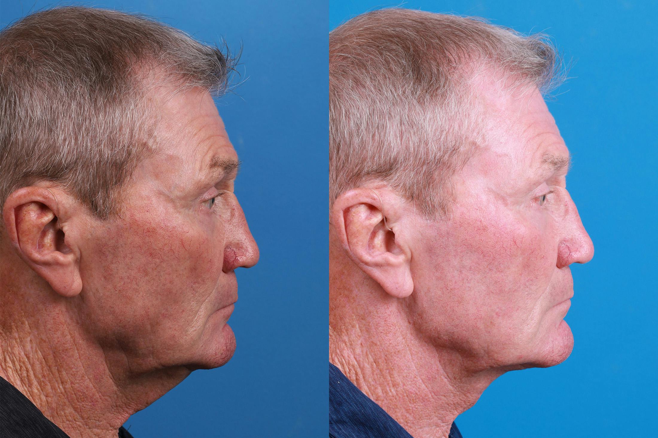 Male Neck Lift Before & After Gallery - Patient 148538117 - Image 3