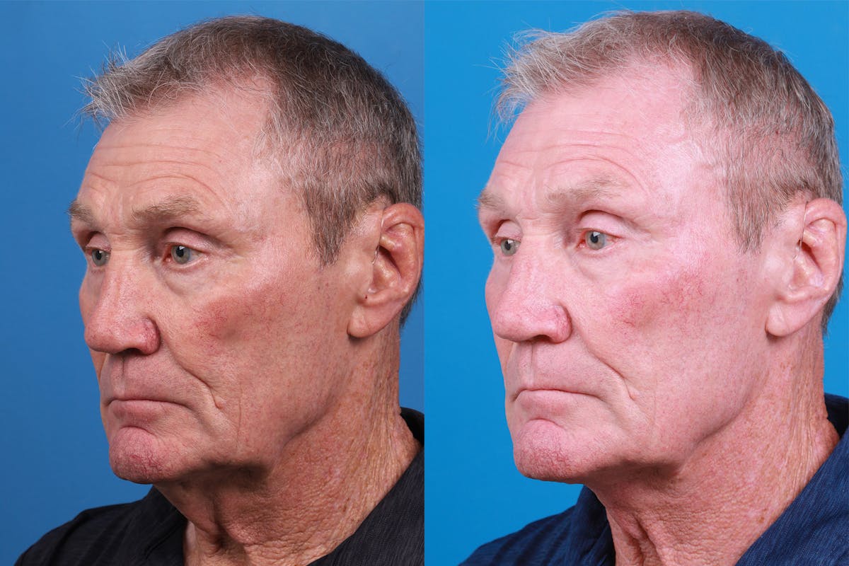 Male Neck Lift Before & After Gallery - Patient 148538117 - Image 4