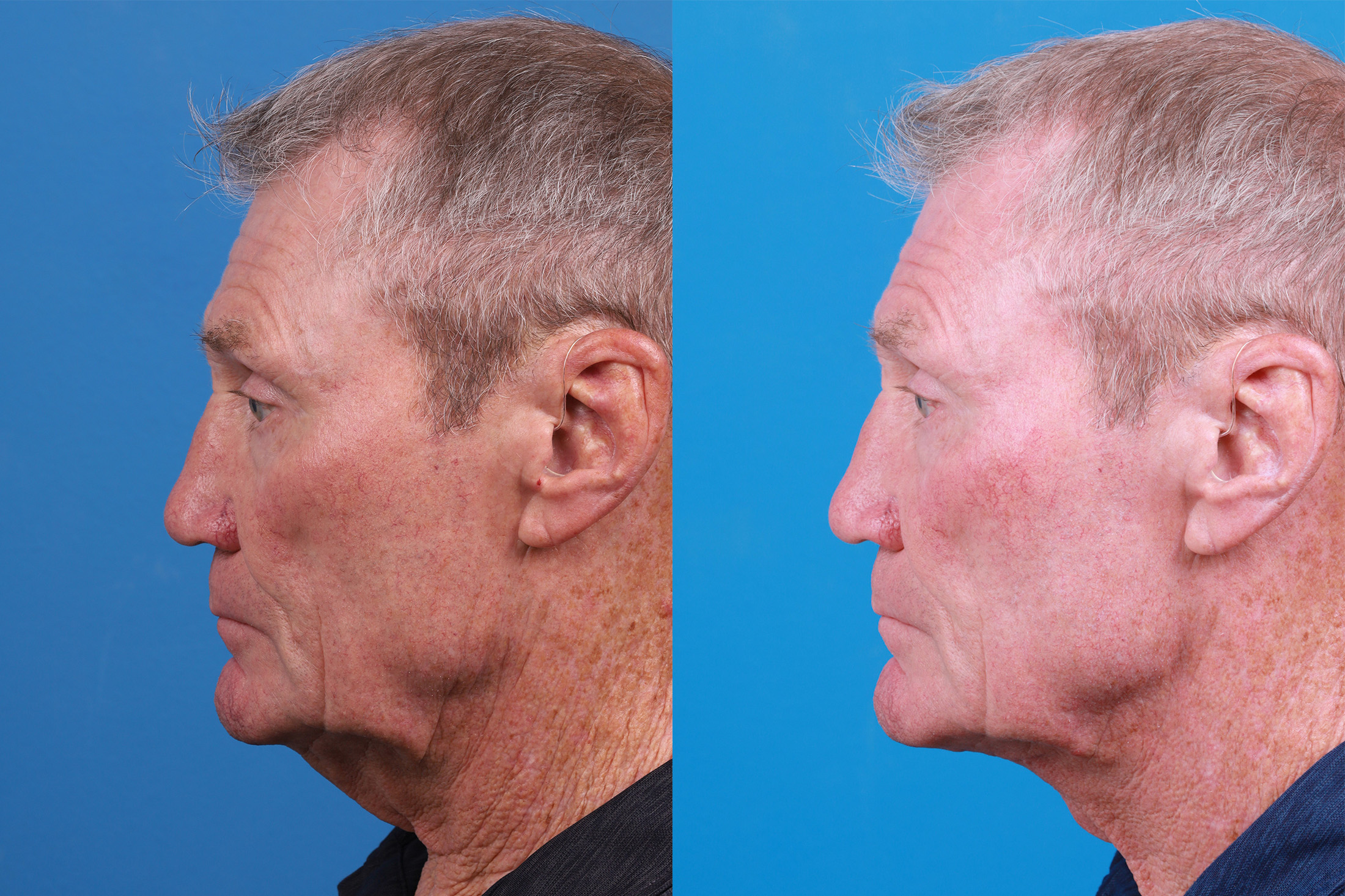 Male Neck Lift Before & After Gallery - Patient 148538117 - Image 5