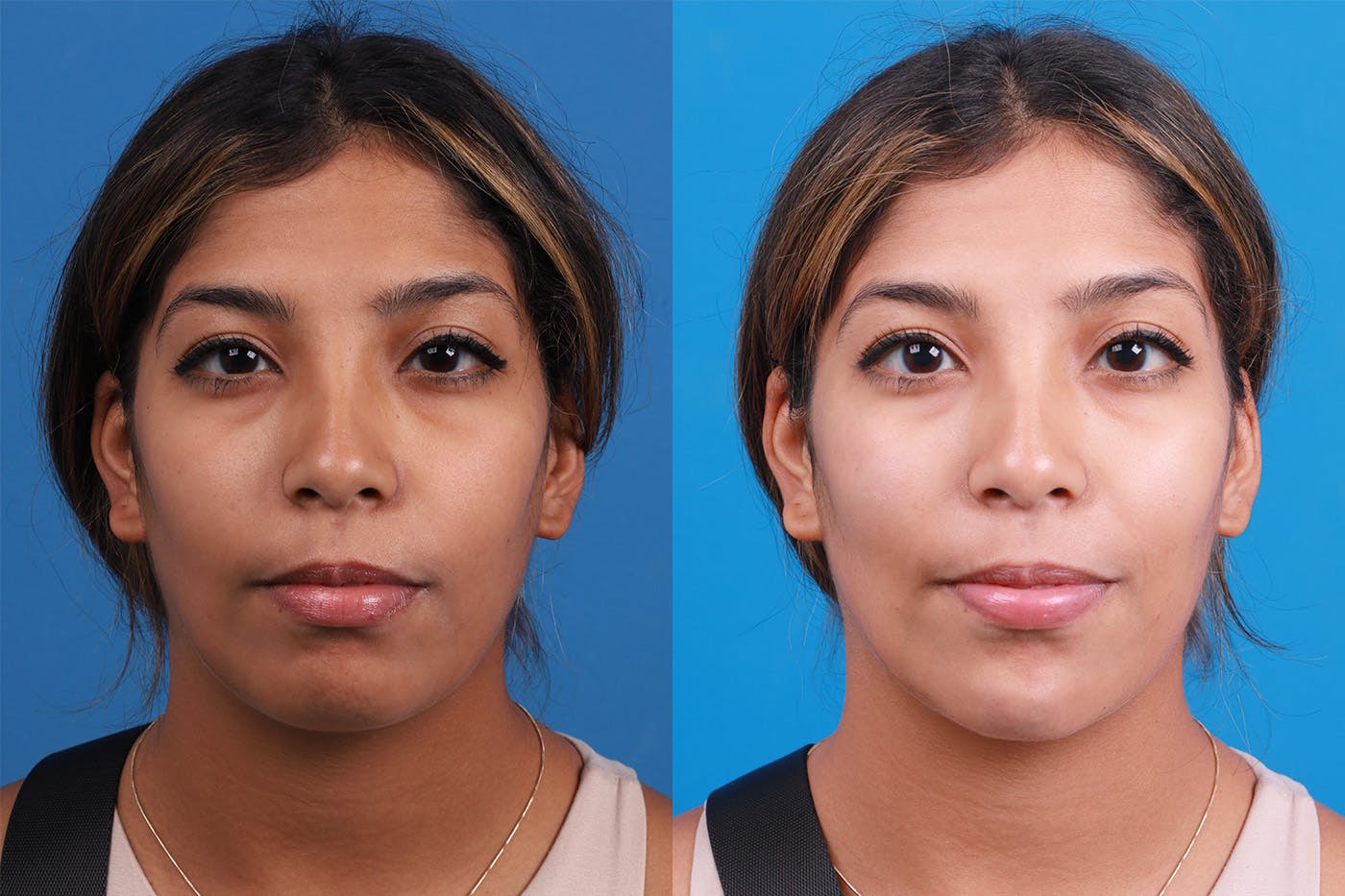 Dermal Fillers Before & After Gallery - Patient 148538569 - Image 1