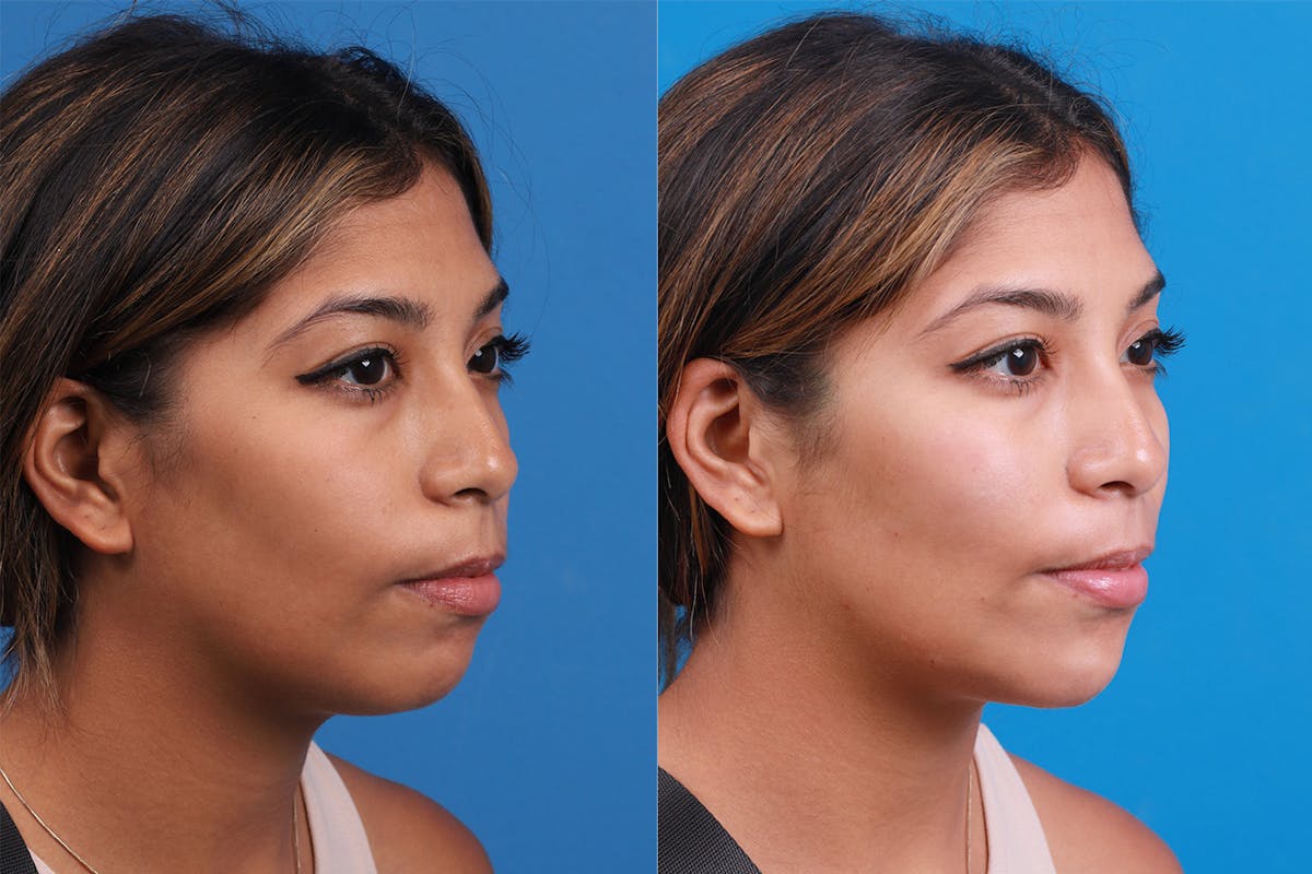 Dermal Fillers Before & After Gallery - Patient 148538569 - Image 2