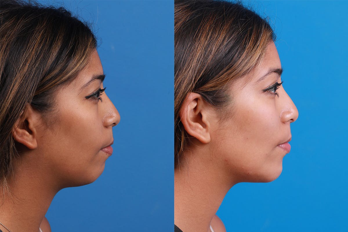 Dermal Fillers Before & After Gallery - Patient 148538569 - Image 3