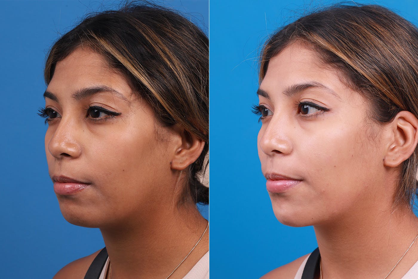 Dermal Fillers Before & After Gallery - Patient 148538569 - Image 4