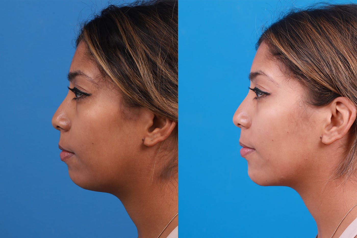 Dermal Fillers Before & After Gallery - Patient 148538569 - Image 5