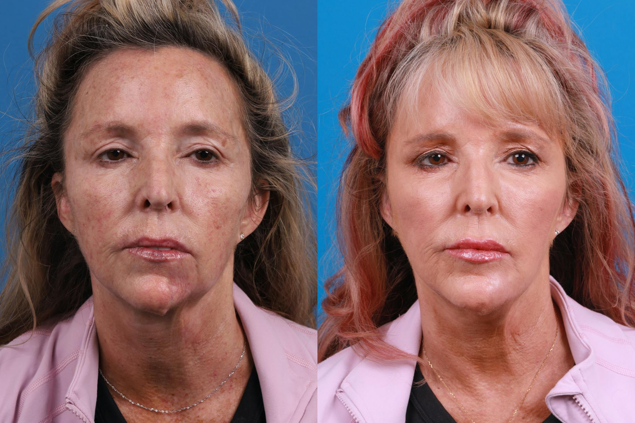 Dermal Fillers Before & After Gallery - Patient 148589580 - Image 1