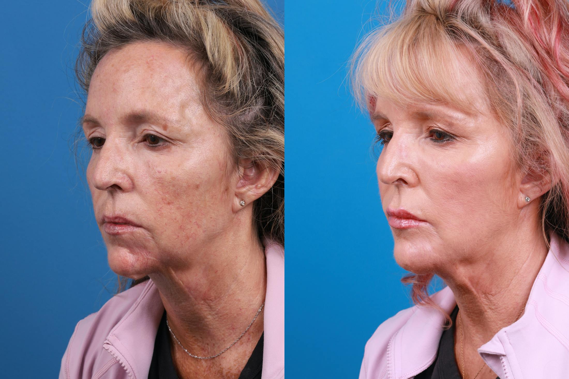 Dermal Fillers Before & After Gallery - Patient 148589580 - Image 2