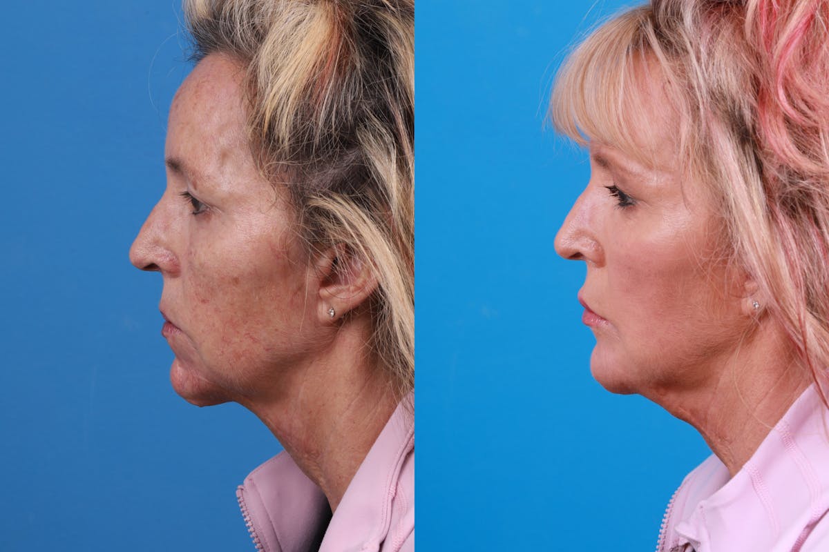 Dermal Fillers Before & After Gallery - Patient 148589580 - Image 3