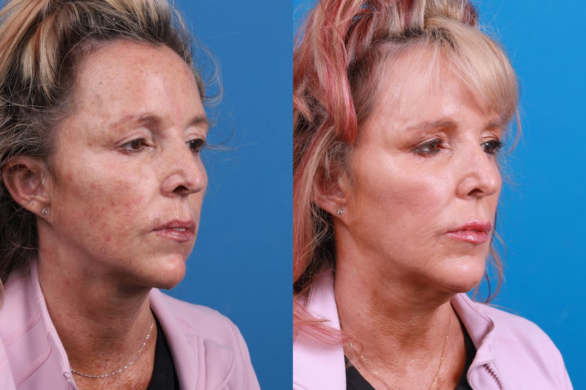 Dermal Fillers Before & After Gallery - Patient 148589580 - Image 4
