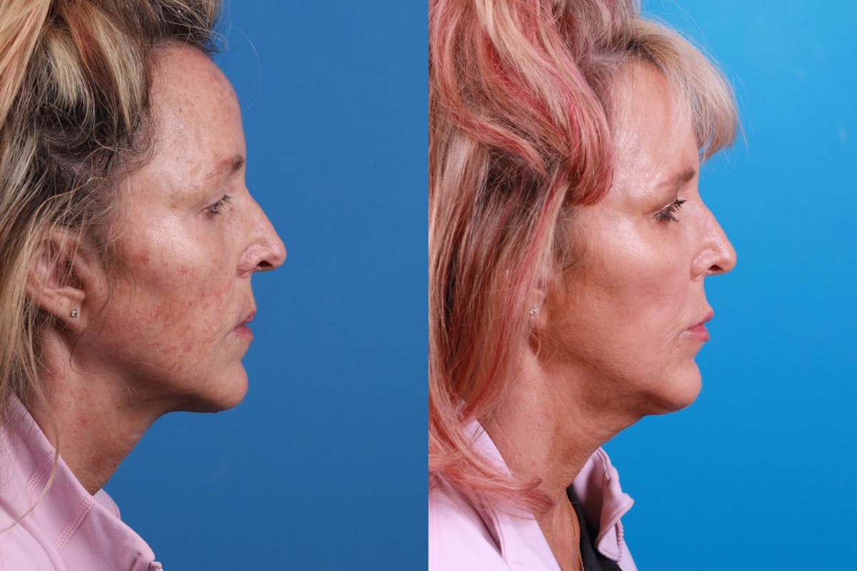 Dermal Fillers Before & After Gallery - Patient 148589580 - Image 5