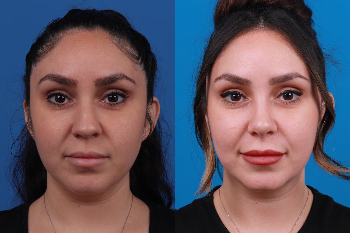 Rhinoplasty Before & After Gallery - Patient 148679015 - Image 1