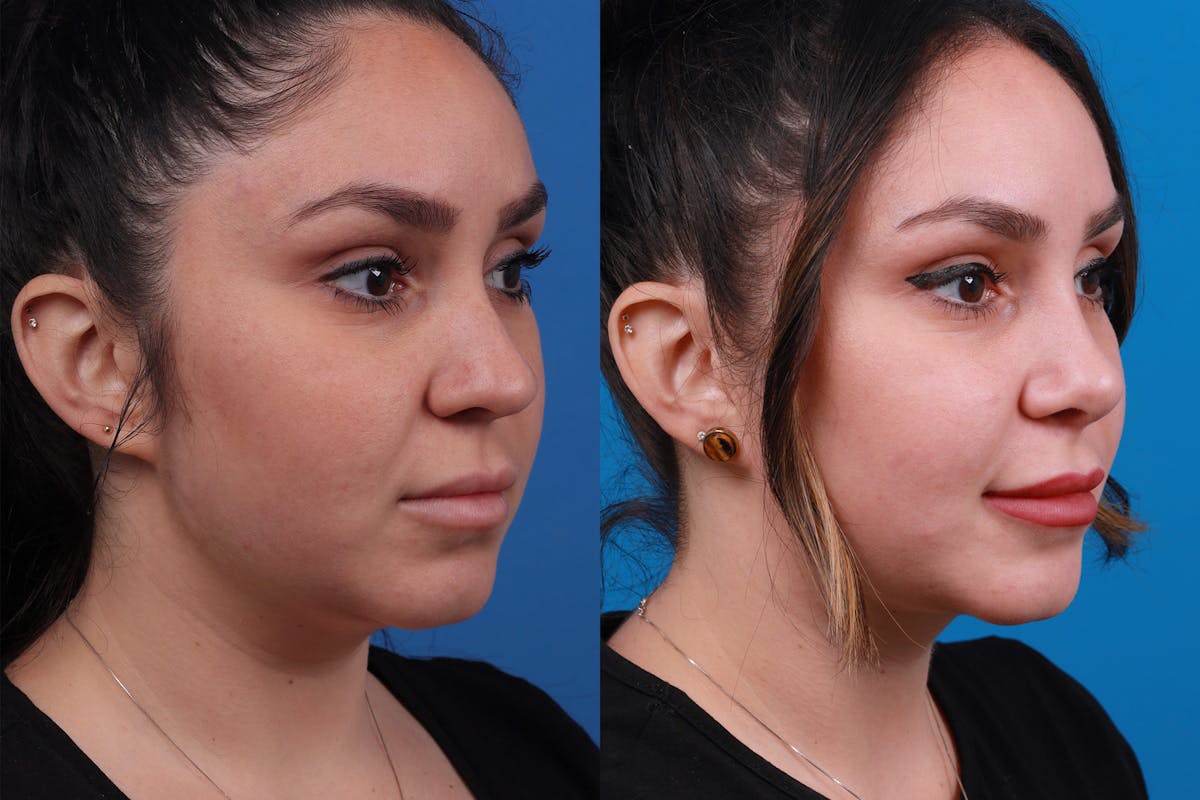 Rhinoplasty Before & After Gallery - Patient 148679015 - Image 2