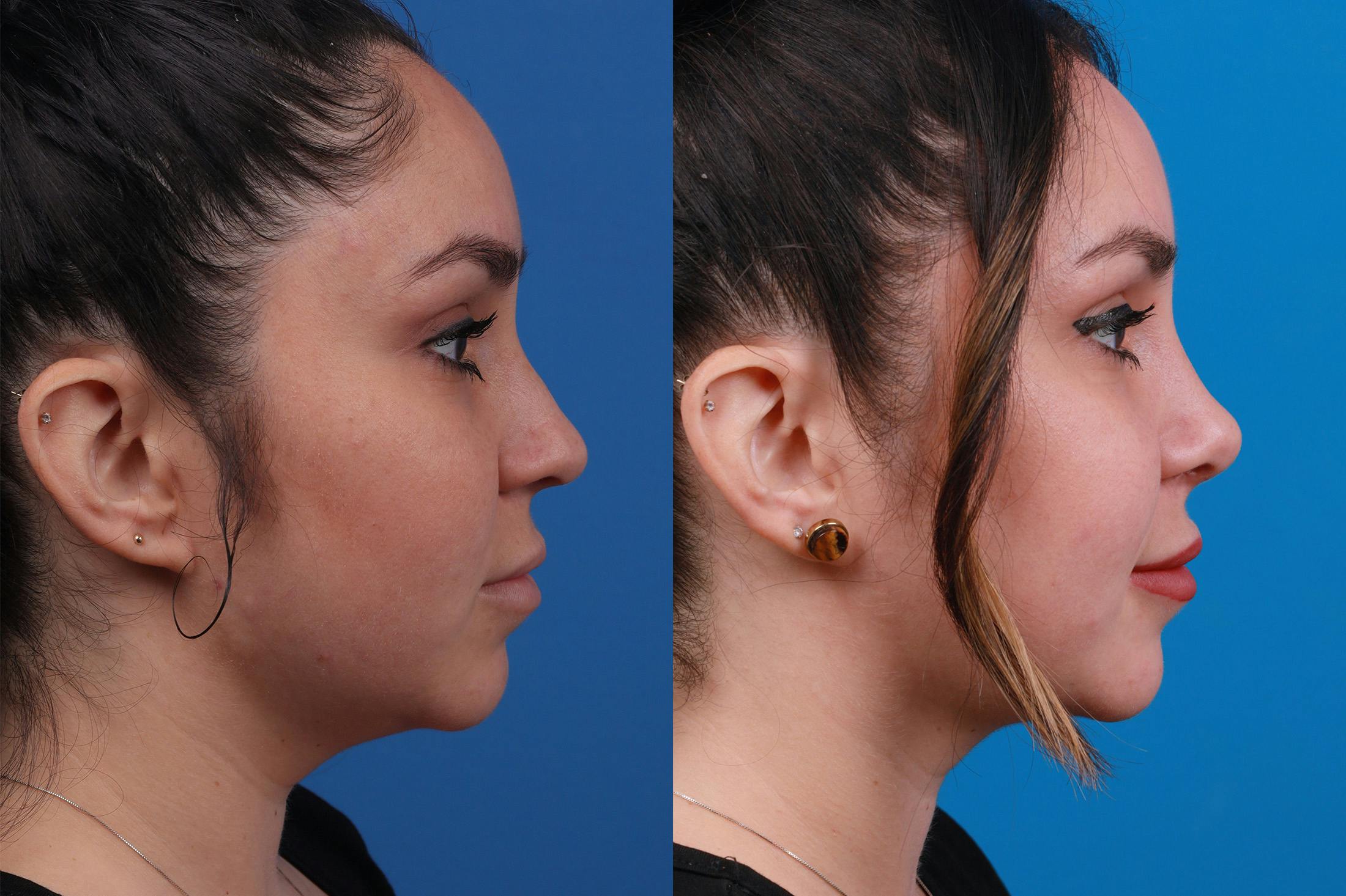 Rhinoplasty Before & After Gallery - Patient 148679015 - Image 3