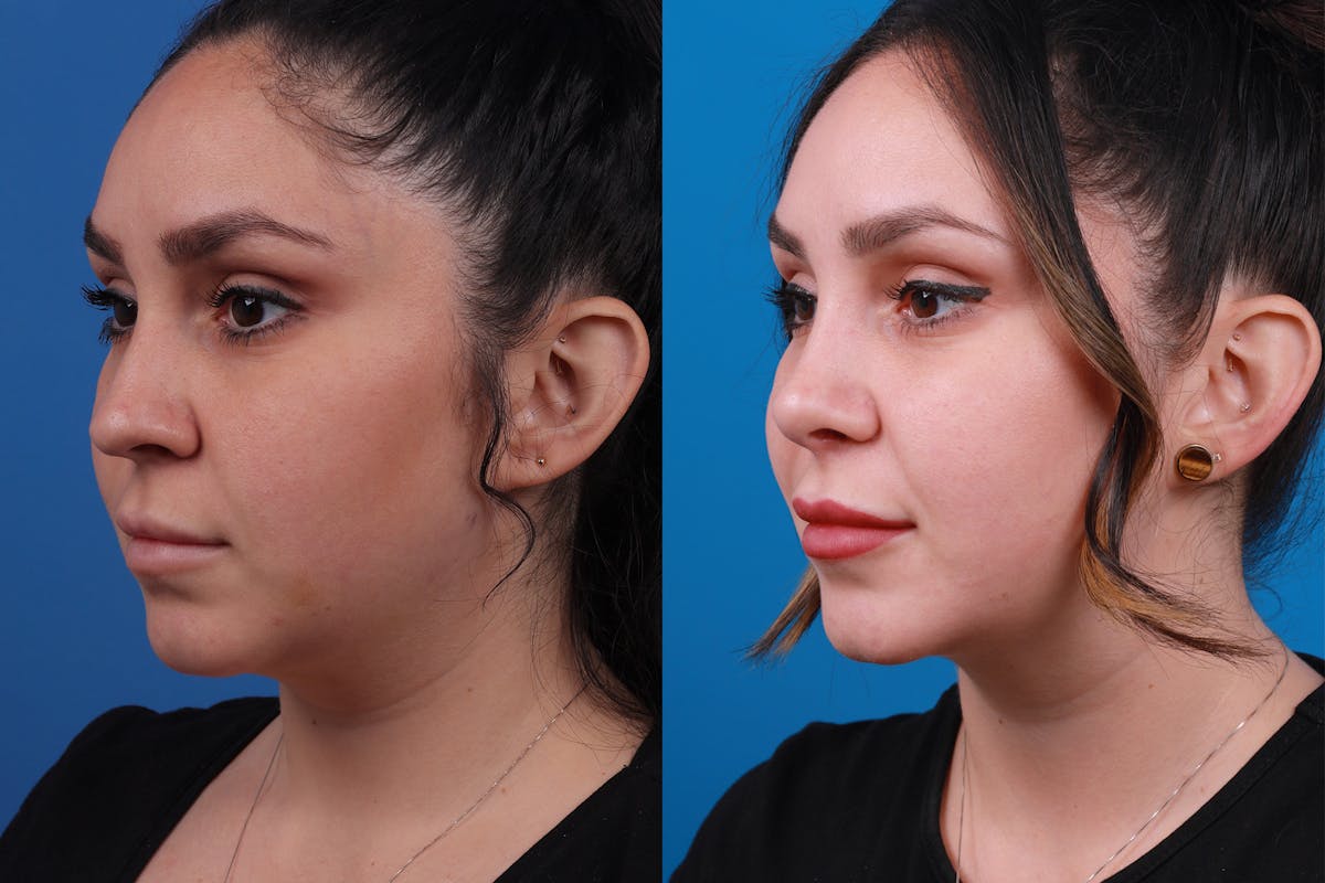 Rhinoplasty Before & After Gallery - Patient 148679015 - Image 4