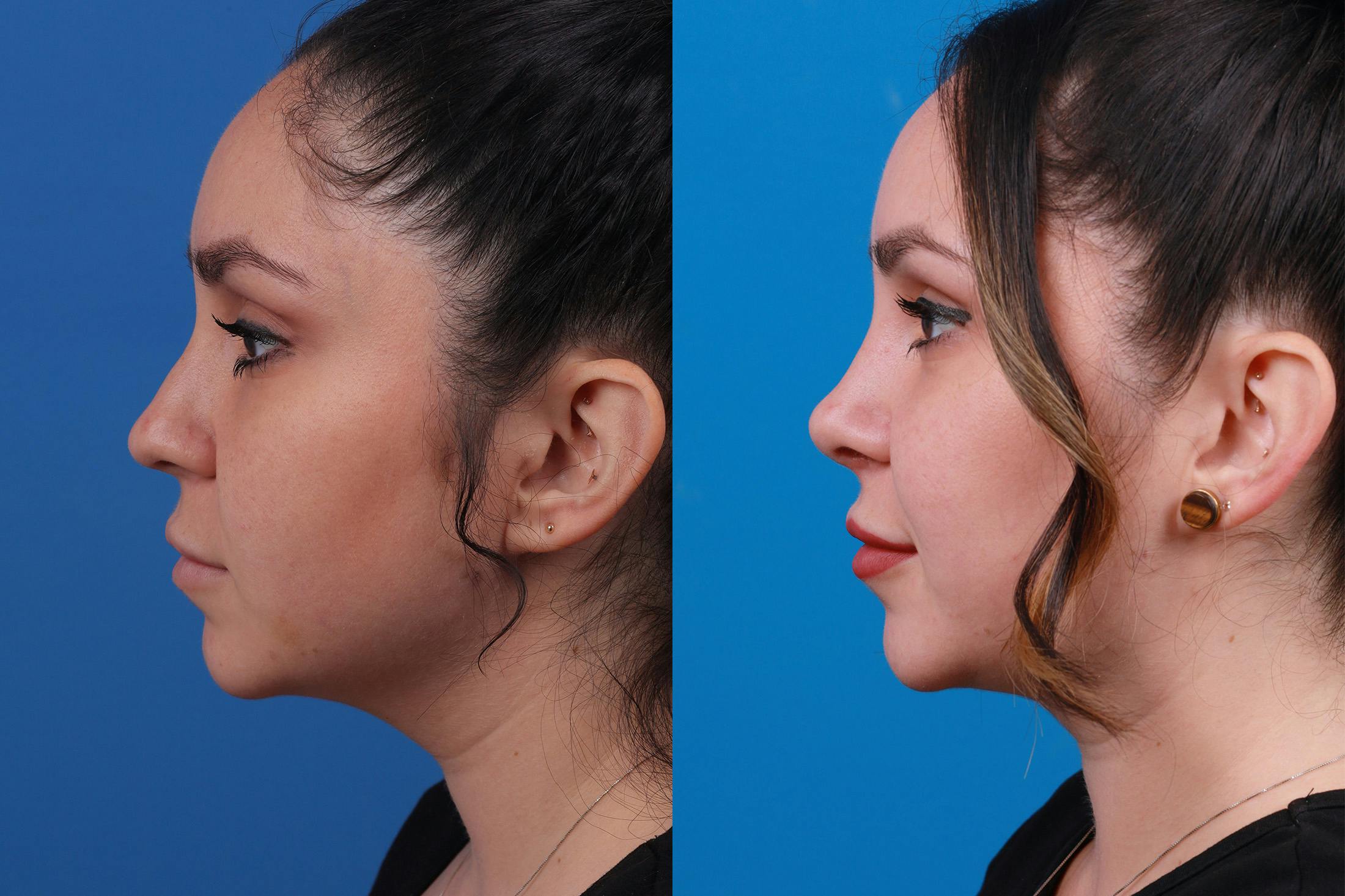 Rhinoplasty Before & After Gallery - Patient 148679015 - Image 5