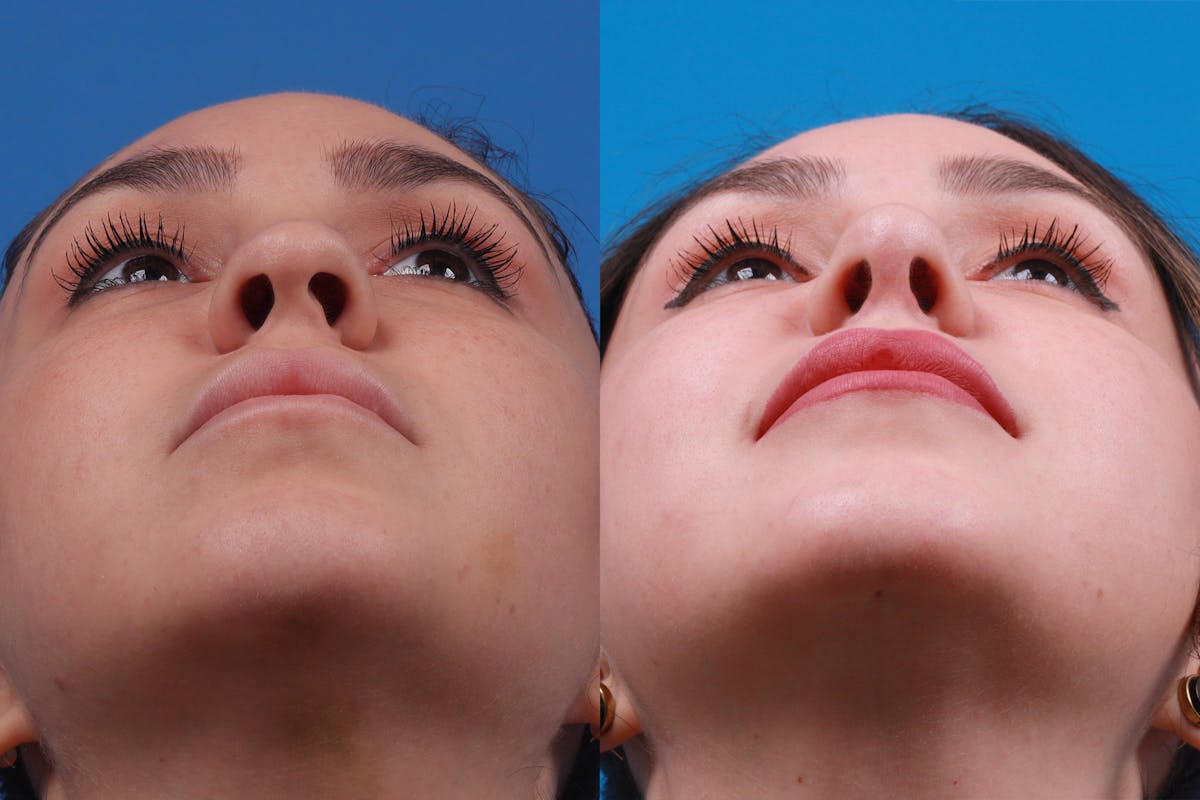 Rhinoplasty Before & After Gallery - Patient 148679015 - Image 6