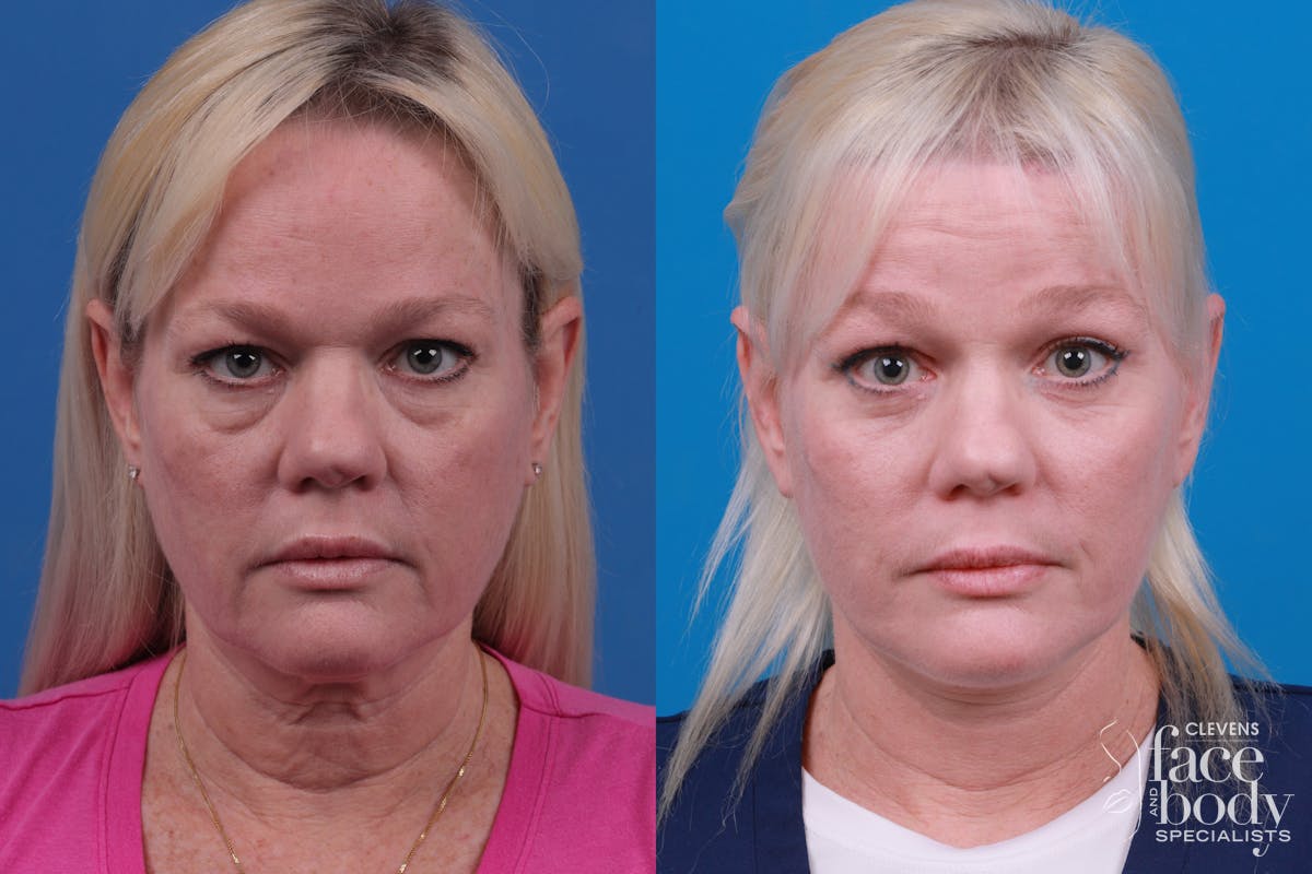 Eyelid Surgery Before & After Gallery - Patient 364160 - Image 1