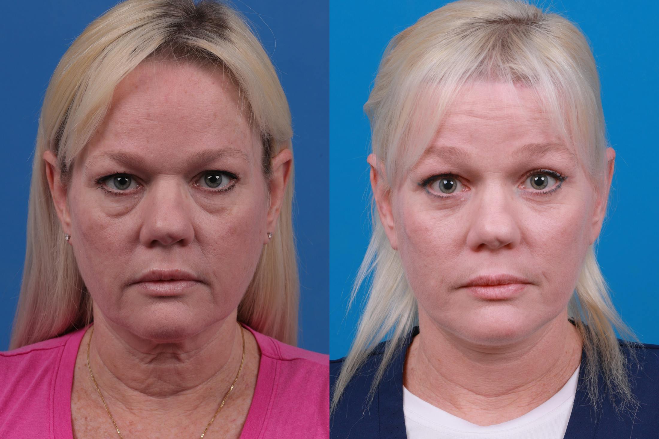 Facelift Before & After Gallery - Patient 148679036 - Image 1