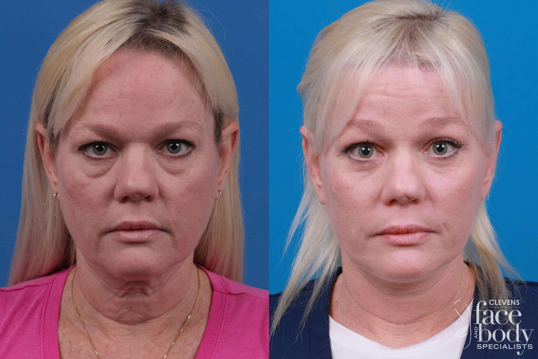 Eyelid Surgery Before & After Gallery - Patient 364160 - Image 1