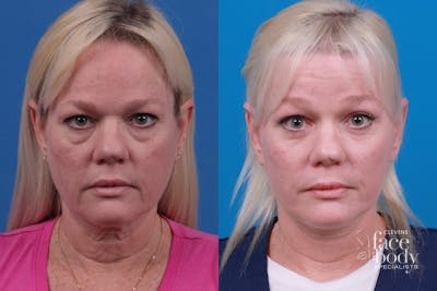 Eyelid Surgery Before & After Gallery - Patient 364160 - Image 1