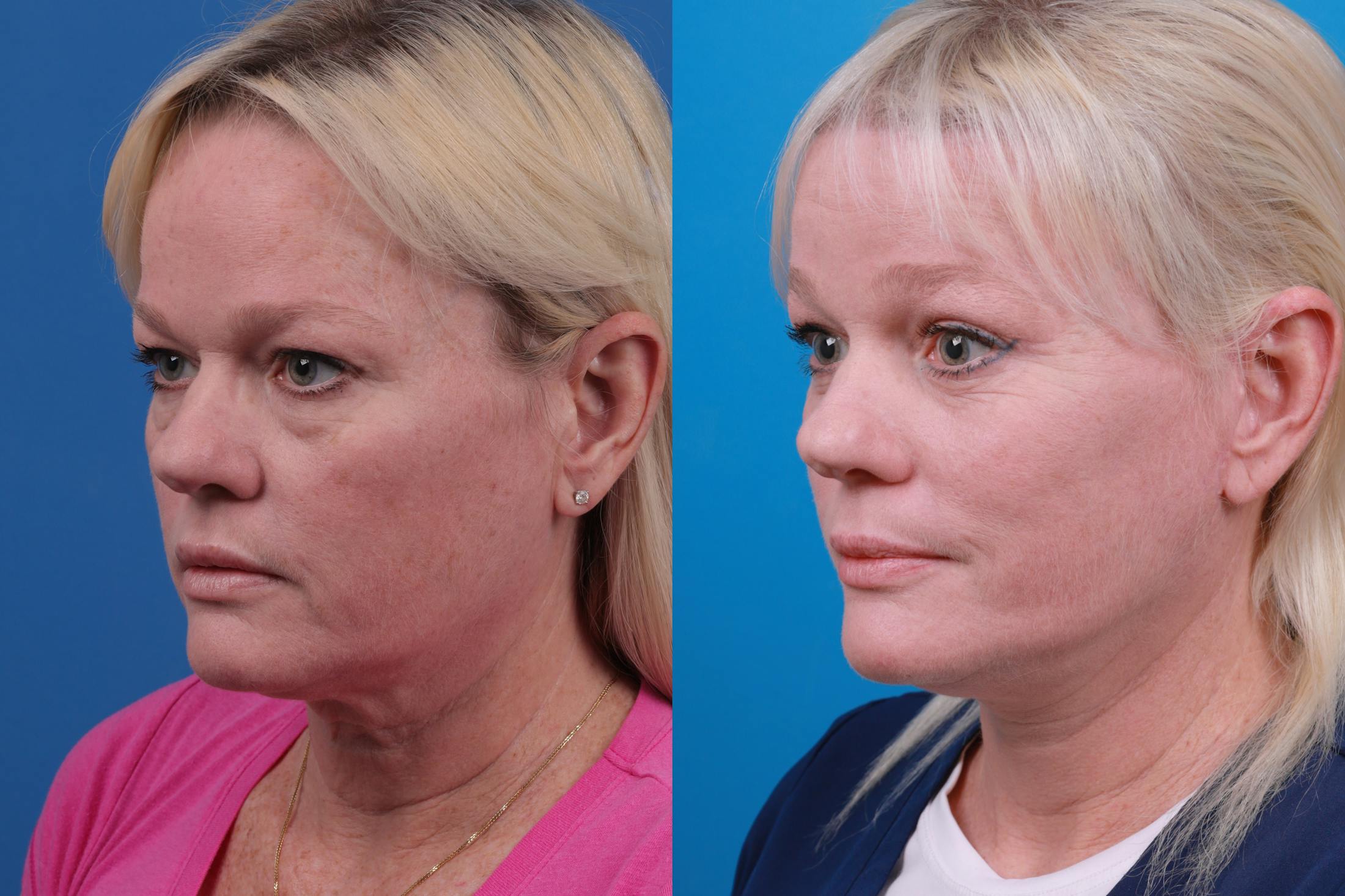 Brow Lift Before & After Gallery - Patient 148679038 - Image 2