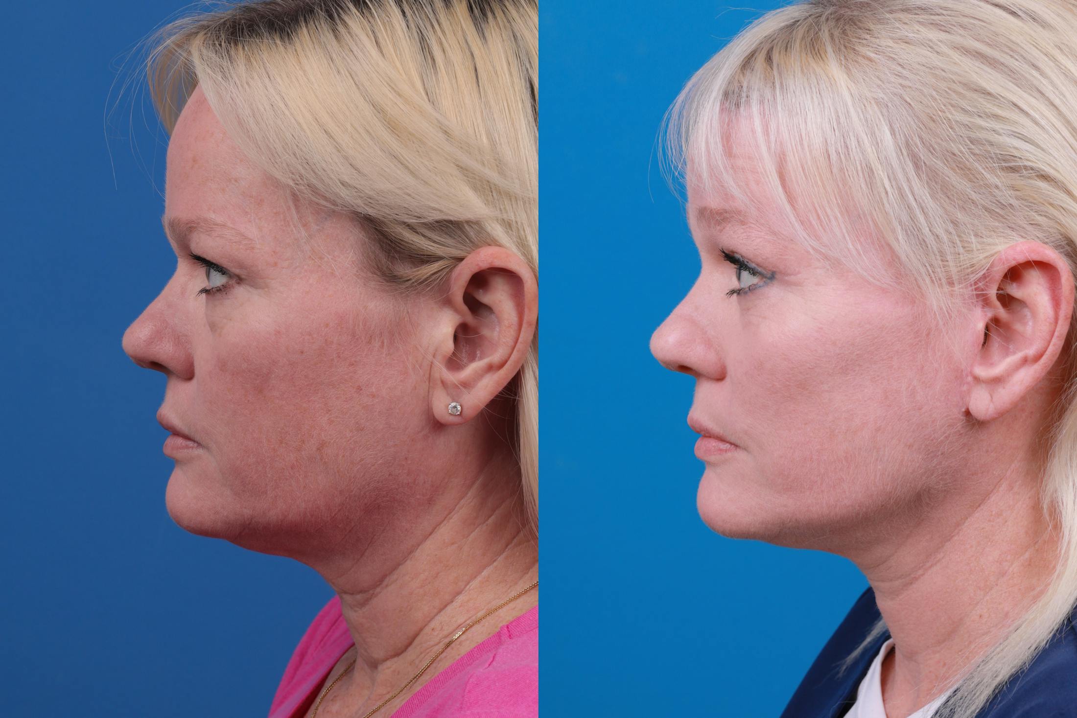 Facelift Before & After Gallery - Patient 148679036 - Image 3