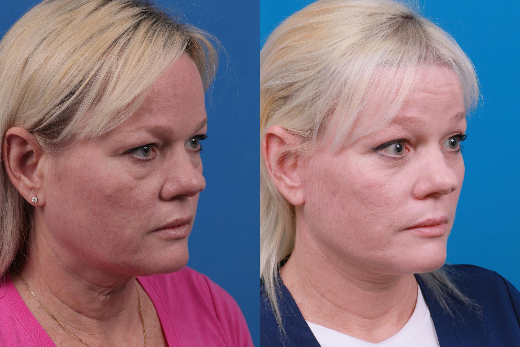 Facelift Before & After Gallery - Patient 148679036 - Image 4