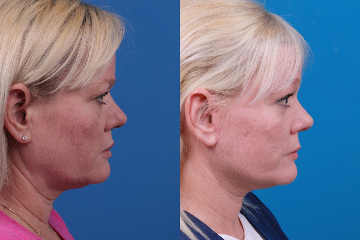 Facelift Before & After Gallery - Patient 148679036 - Image 5