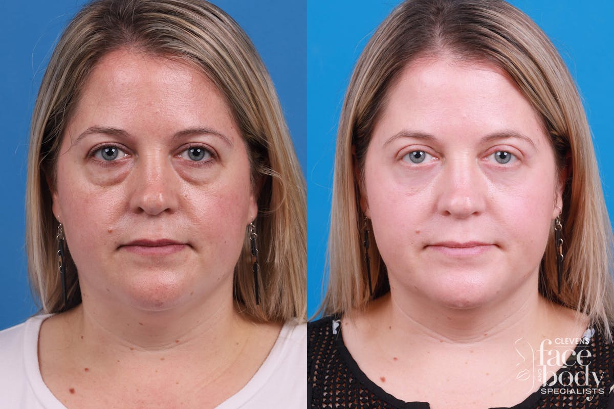 Skin Resurfacing Before & After Gallery - Patient 148734578 - Image 1