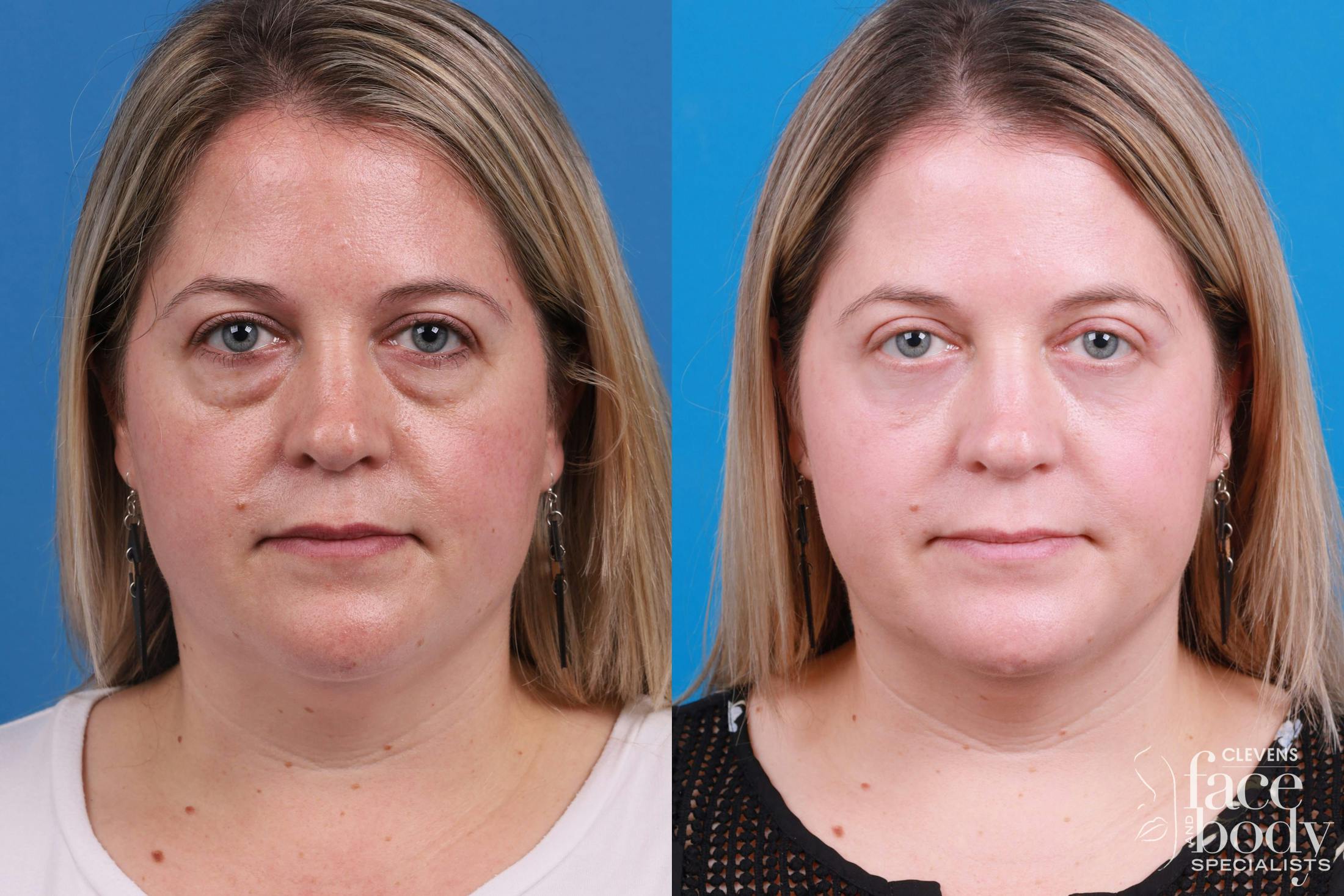 Skin Resurfacing Before & After Gallery - Patient 148734578 - Image 1