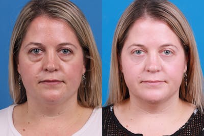 Skin Resurfacing Before & After Gallery - Patient 148734578 - Image 1