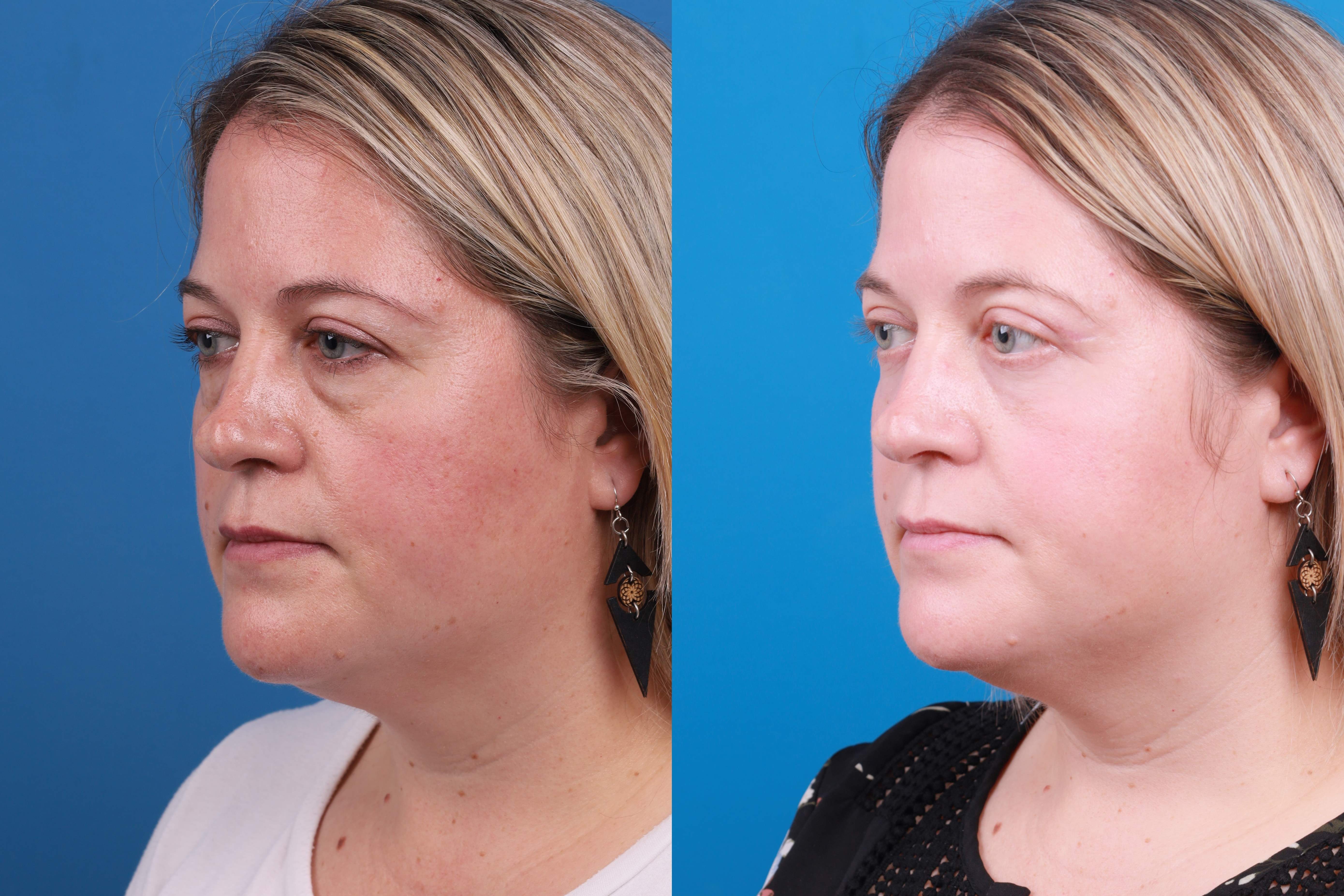 Skin Resurfacing Before & After Gallery - Patient 148734578 - Image 2