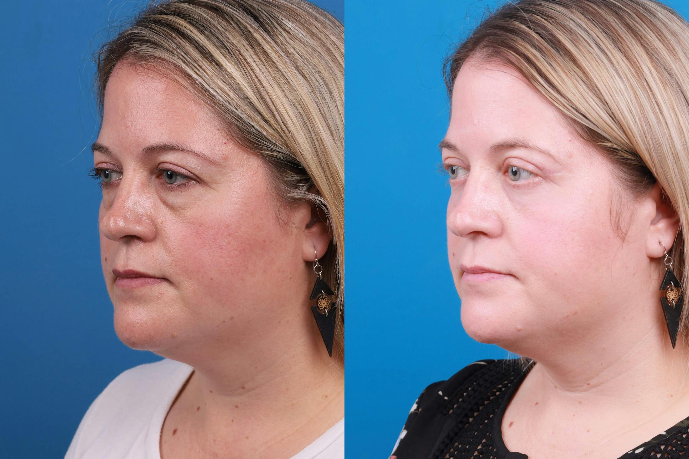 Skin Resurfacing Before & After Gallery - Patient 148734578 - Image 2