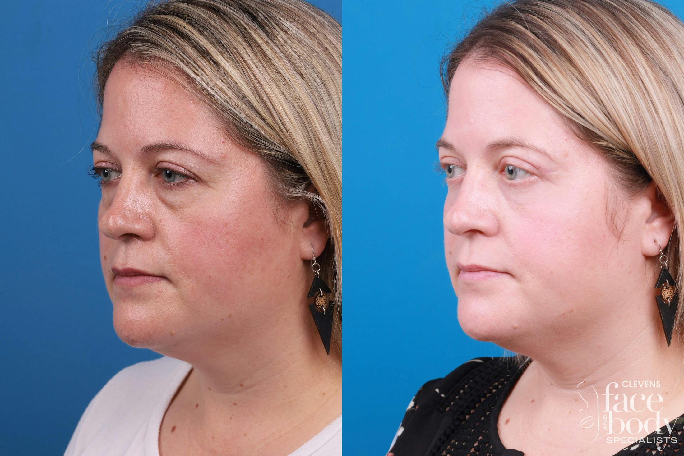 Skin Resurfacing Before & After Gallery - Patient 148734578 - Image 2
